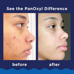 Panoxyl Acne Foaming Wash Benzoyl Peroxide 10% -156 g